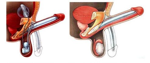 Prótesis de pene con prótesis inflable (izquierda) y de plástico (derecha)