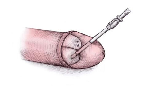 La cabeza del pene se puede agrandar inyectándole gel hialurónico.