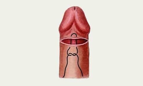 glande del pene