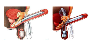 prótesis de pene