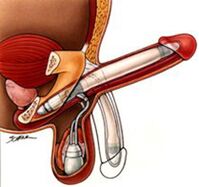 Implantes masculinos de alargamiento del pene