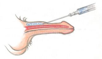 Inyección voluminizadora de ácido hialurónico en el pene